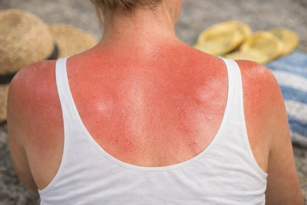 comment faire dérougir un coup de soleil