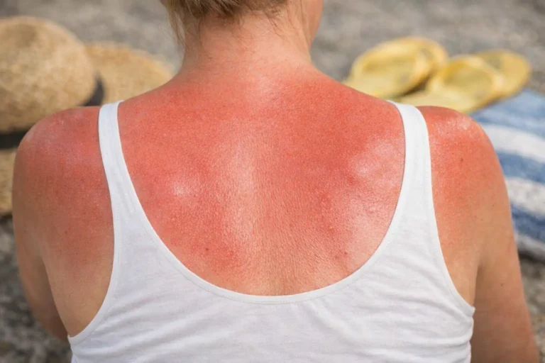 comment faire dérougir un coup de soleil